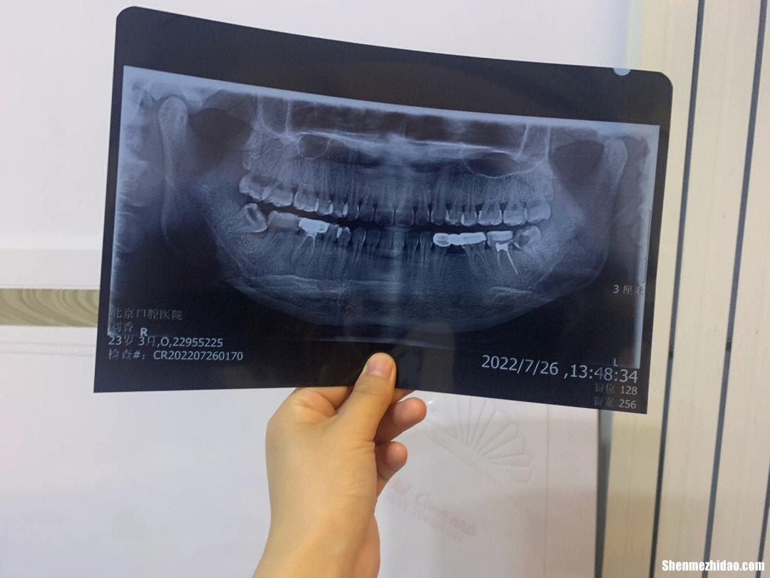 拔智齿热敷多久 拔智齿热敷多久一次