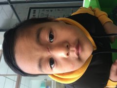 鼻梁撞青多久好 鼻梁撞青多久好恢复