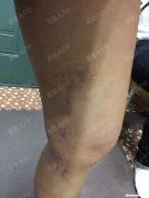 於紫多久才能自然好 淤紫什么时候能消下去