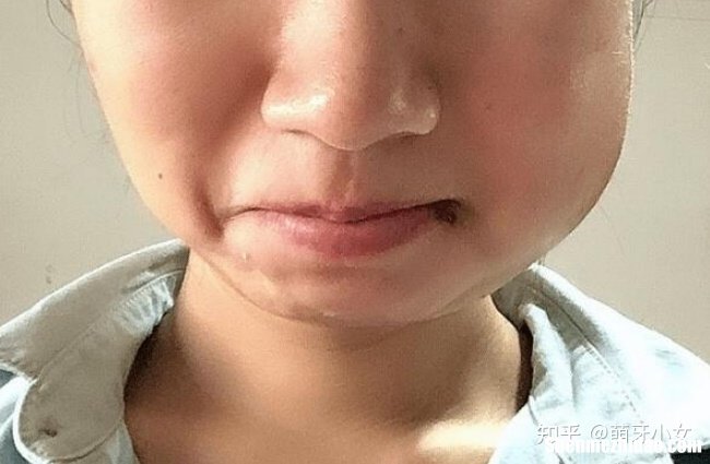 拔牙缝针肿多久能好 拔智齿缝针后肿了怎么办