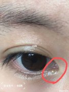 脂肪粒自己消失要多久 脂肪粒自己消失要多久恢复
