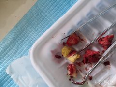 拔智齿后会疼多久 拔智齿后会疼多久正常