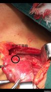 甲状腺切除多久能恢复 甲状腺切除多久恢复声音