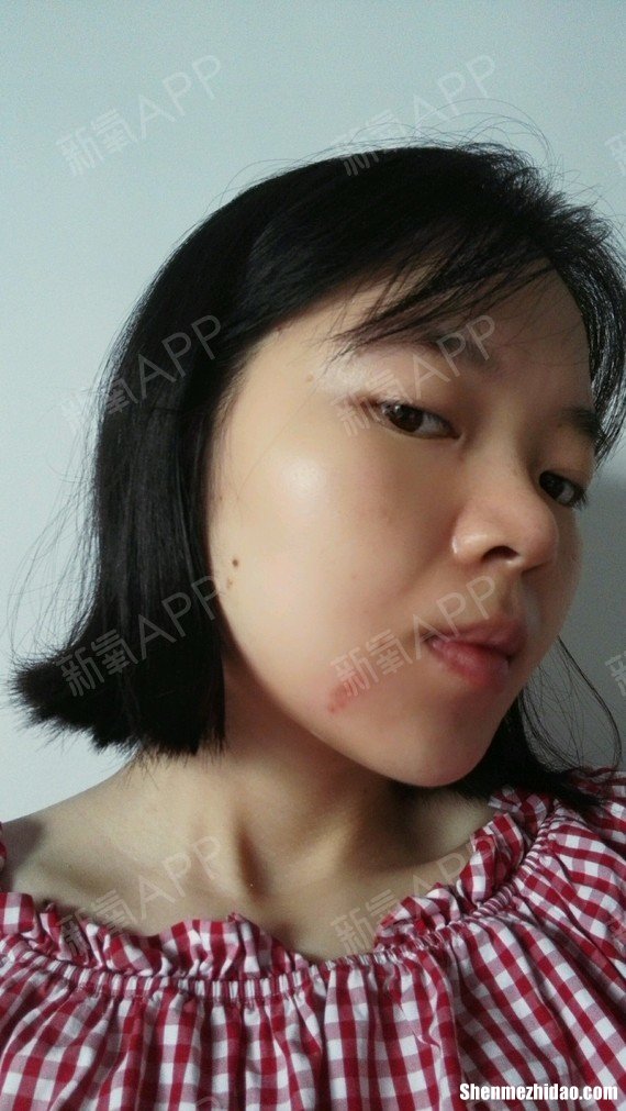 脂肪填充针眼多久掉痂 脂肪填充针眼处长了个包