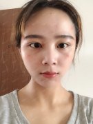 脂肪填充针眼多久掉痂 脂肪填充针眼处长了个包