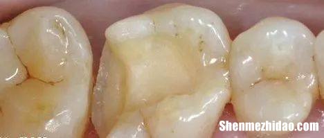 补牙掉了怎么办 补的牙齿掉了怎么办