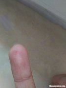 针灸后针眼多久会好 针灸后针眼多久会好起来