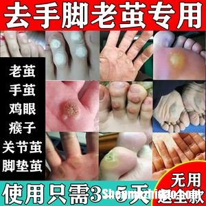 脚指头磨出茧子怎么办 脚指上磨出的茧怎么去除