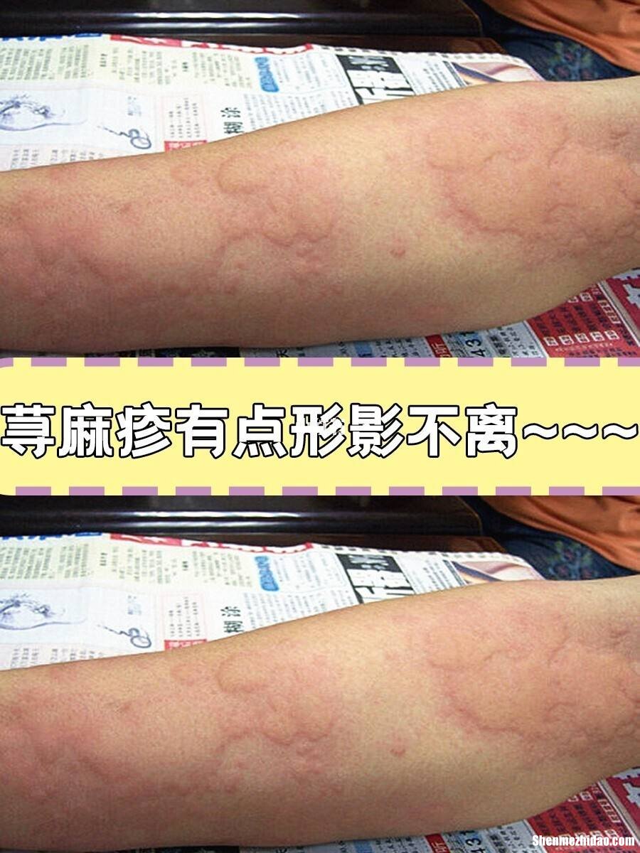 得了荨麻疹手又肿又痒怎么办 得了荨麻疹手又肿又痒怎么办用什么药