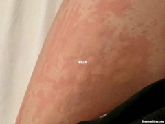 得了荨麻疹手又肿又痒怎么办 得了荨麻疹手又肿又痒怎么办用什么药