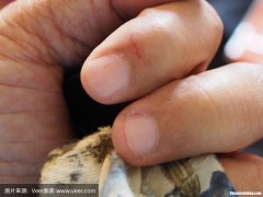 刀伤出血过多多久能恢复 刀伤出血过多多久能恢复正常