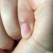 指甲上有坑是怎么回事 大拇指指甲上有坑是怎么回事