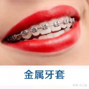 40岁带牙套多久矫正好 40岁带牙套多久矫正好一点