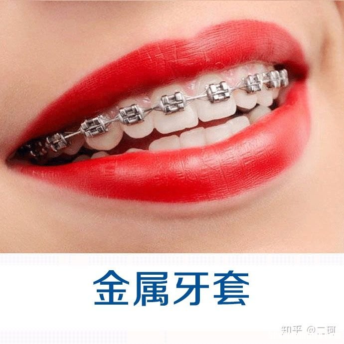 40岁带牙套多久矫正好 40岁带牙套多久矫正好一点