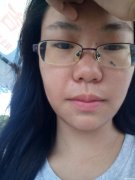 脸上长黑痣去掉多少钱 我脸上有黑痣去了好不去好