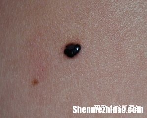 脸上长黑痣去掉多少钱 我脸上有黑痣去了好不去好