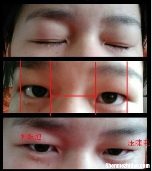 肉泡眼怎么消除 肉眼泡会自己消失吗