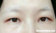 肉泡眼怎么消除 肉眼泡会自己消失吗