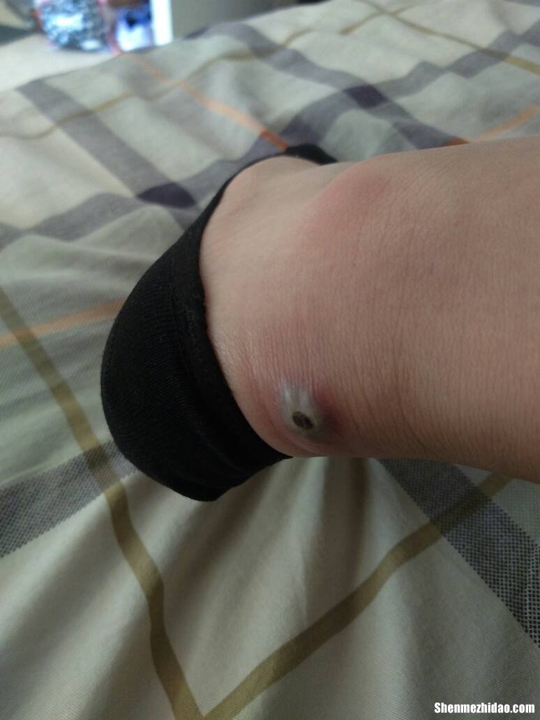脚被鞋子磨起泡怎么办 皮鞋磨脚怎么处理就不磨脚了