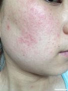 脸上皮肤痒怎么回事 脸上特别痒是怎么回事