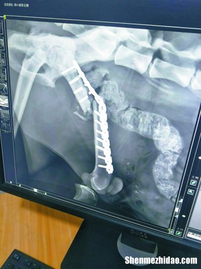 股骨头打钢钉多久恢复 股骨头打完钢钉多长时间可以下地