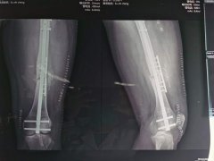 股骨头打钢钉多久恢复 股骨头打完钢钉多长时间可以下地