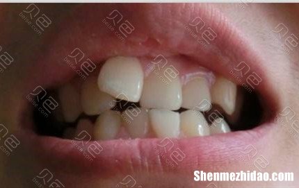 成人牙齿不整齐怎么办 成人牙齿不整齐怎么办?