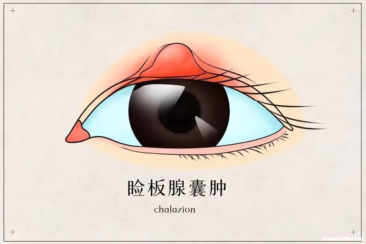 眼板腺炎怎么引起的 眼板腺炎用什么眼药水