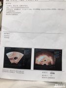 宫腔积液最长可排多久 宫腔积液最后会排出来吗