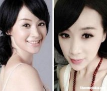整容为什么脸僵 为什么整容后会出现面部肿胀