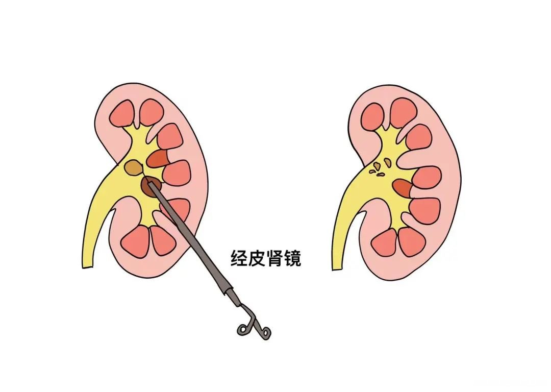 经皮肾镜手术后多久拔导尿管 经皮肾镜术后尿管拔除最佳时机