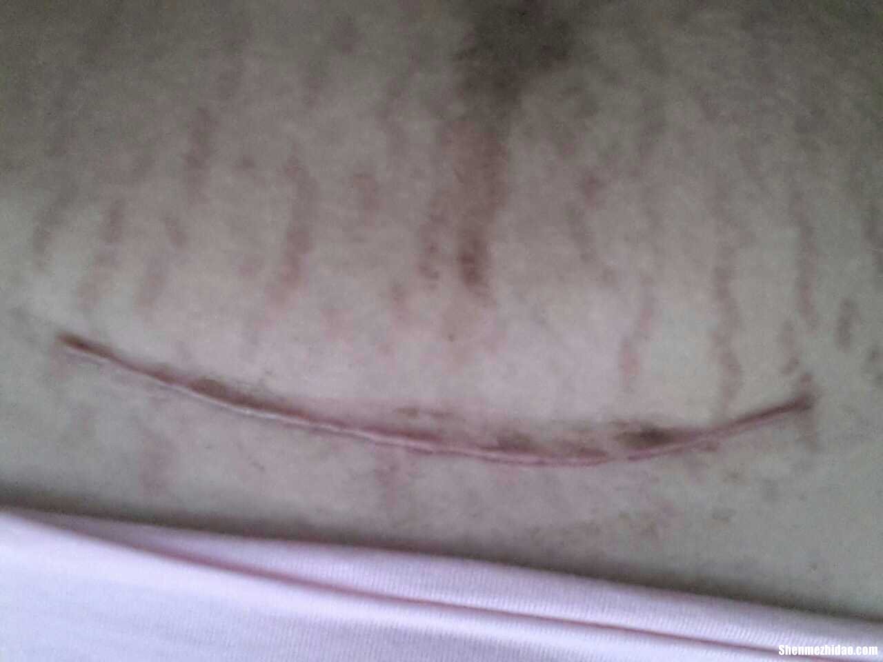 第二次刨腹产多久能不疼 第二次剖腹产多久才可以同房
