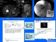 子宫小结节怎么治疗 子宫有小结节是什么意思