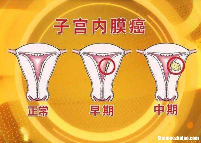 宫外孕多久容易爆血管 宫外孕多久会流血 流多久呢