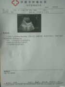 宫外孕多久容易爆血管 宫外孕多久会流血 流多久呢
