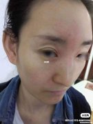 过敏脸肿了输液多久 脸过敏肿了输液管事吗