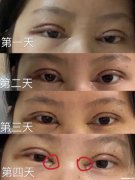 双眼皮没割好多久可以 割双眼皮没割好,多久可以割第二次