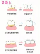 洗牙多久恢复 拔牙几天可以刷牙