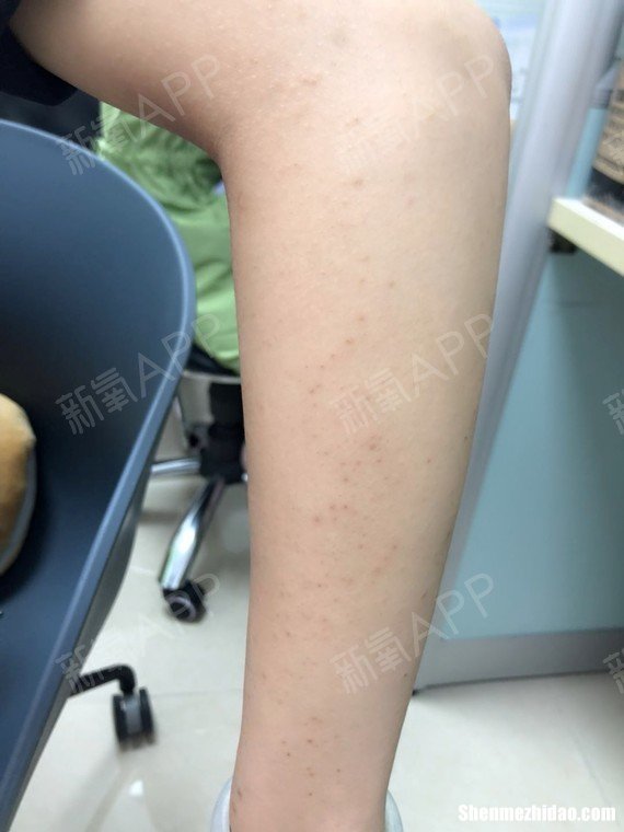 激光脱毛隔多久脱一次 激光脱毛要间隔多久做一次