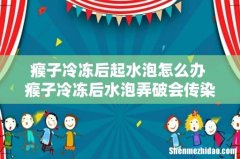 瘊子冷冻后起水泡怎么办 瘊子冷冻后水泡弄破会传染吗