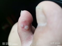 疣病毒怎么治疗 疣病毒怎么引起的
