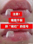 嘴巴烂要多久才好 嘴巴烂要多久才好呢