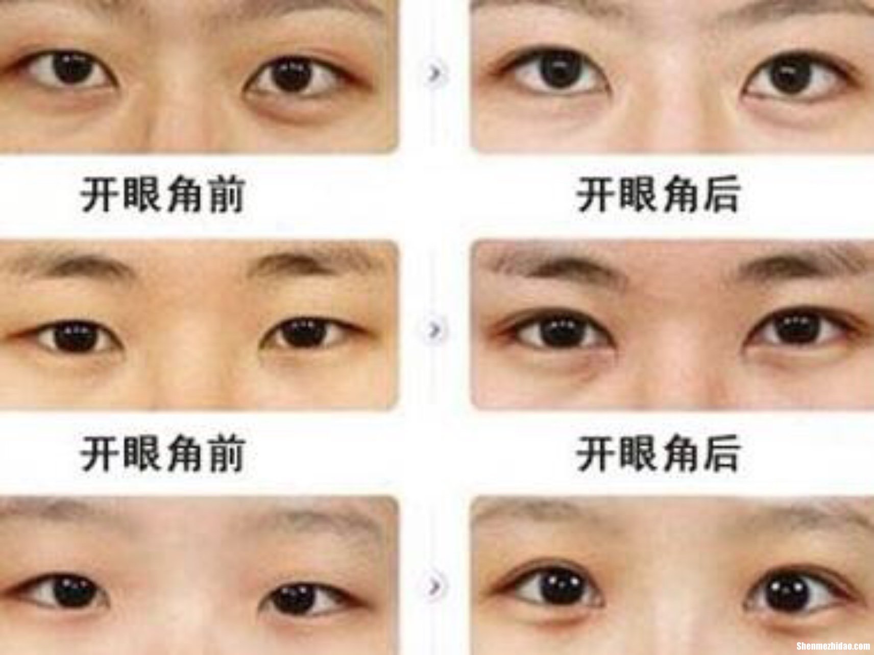 开眼角多久可以同房 开眼角多久可以洗脸化妆