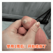 疣子怎么治打针 疣打针一般要多久能好