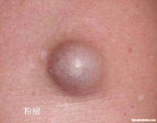 会阴囊肿引流伤口洞多久愈合