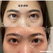 眼袋手术后多久能恢复正常 眼袋手术后多久能恢复正常外切