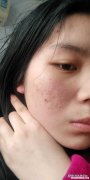 三十多岁的那女人长痤疮怎么办 三十多岁的那女人长痤疮怎么办呢