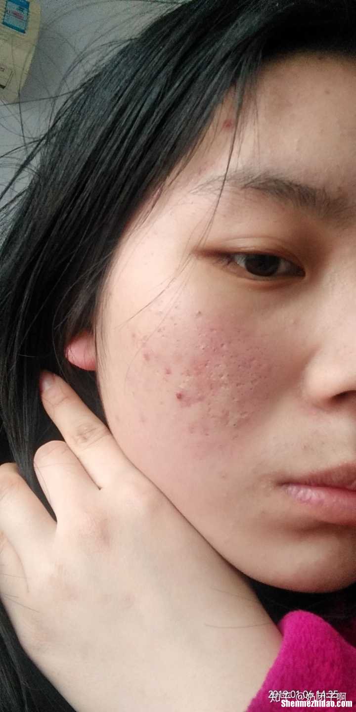 三十多岁的那女人长痤疮怎么办 三十多岁的那女人长痤疮怎么办呢