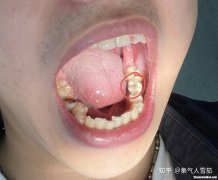 大牙拔掉了牙肉怎么有缝隙 大牙拔掉了牙肉怎么有缝隙呢