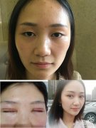 双眼皮压多久恢复 压的双眼皮多久能消肿